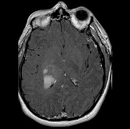 Tumor vs non-tumor 52 y.o male: MRI #1 - rule out stroke, MRI #2 - tumor?