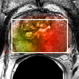 MRI/MRSI Data Display UCSF Prostate Cancer T2