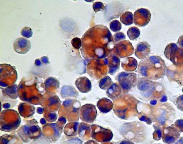 Oil red O staining of alveolar macrophages recovered by BAL