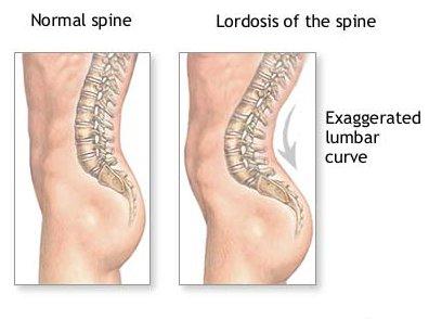 Figure 2: Curvature of a Normal Spine vs.