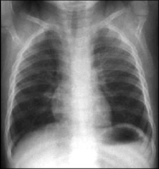9, 56 segs, 32 lymphs, 12 monos, Hgb 12, Hct 38, platelets adequate. Na 132, K 4.2, Cl 100, Bicarb 21, BUN 14, Cr 0.7, glucose 94. A chest radiograph was obtained.