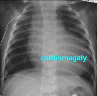 Congenital heart disease often presents as a respiratory condition Arterial desaturation Wheezing Knee-to-chest (fetal) position is part of the management of tetralogy (tet) spells Excessive FiO 2