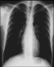 Severe Acute Chest Pain in a Tall Slender Teenager Volume 3, Case 13 - Loren G. Yamamoto, M.D., MPH Severe Acute Chest Pain in a Tall Slender Teenager Volume 3, Case 13 - Loren G. Yamamoto, M.D., MPH He is tall & thin.