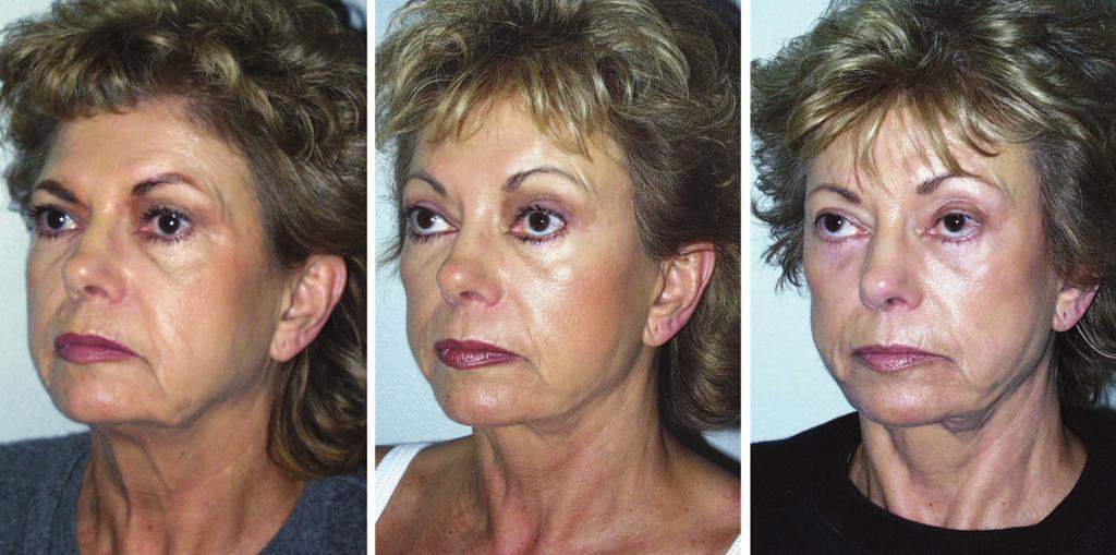 Plastic and Reconstructive Surgery July 2010 Fig. 3. (Left) A 40-year-old woman before her primary face lift. (Center) Patient s appearance 1 year after her primary face lift.