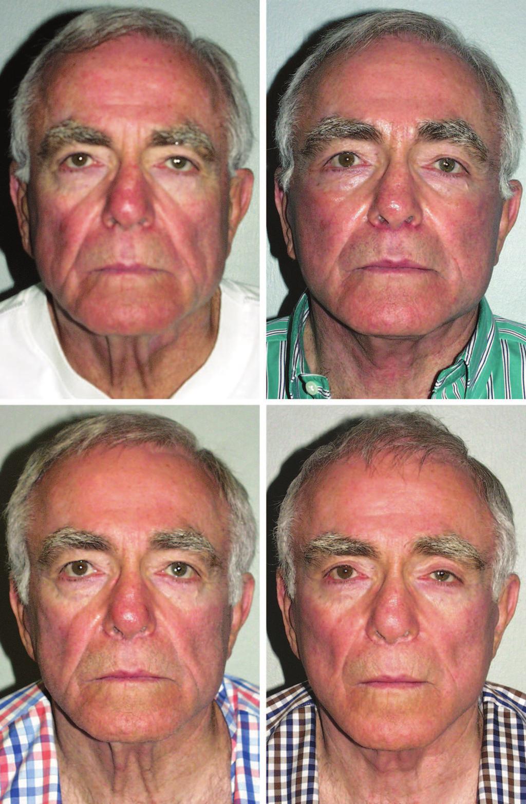 Volume 126, Number 1 Longevity of SMAS Surgery tertiary face lift. Therefore, it is important to be able to accurately convey the longevity of the face lift procedure.