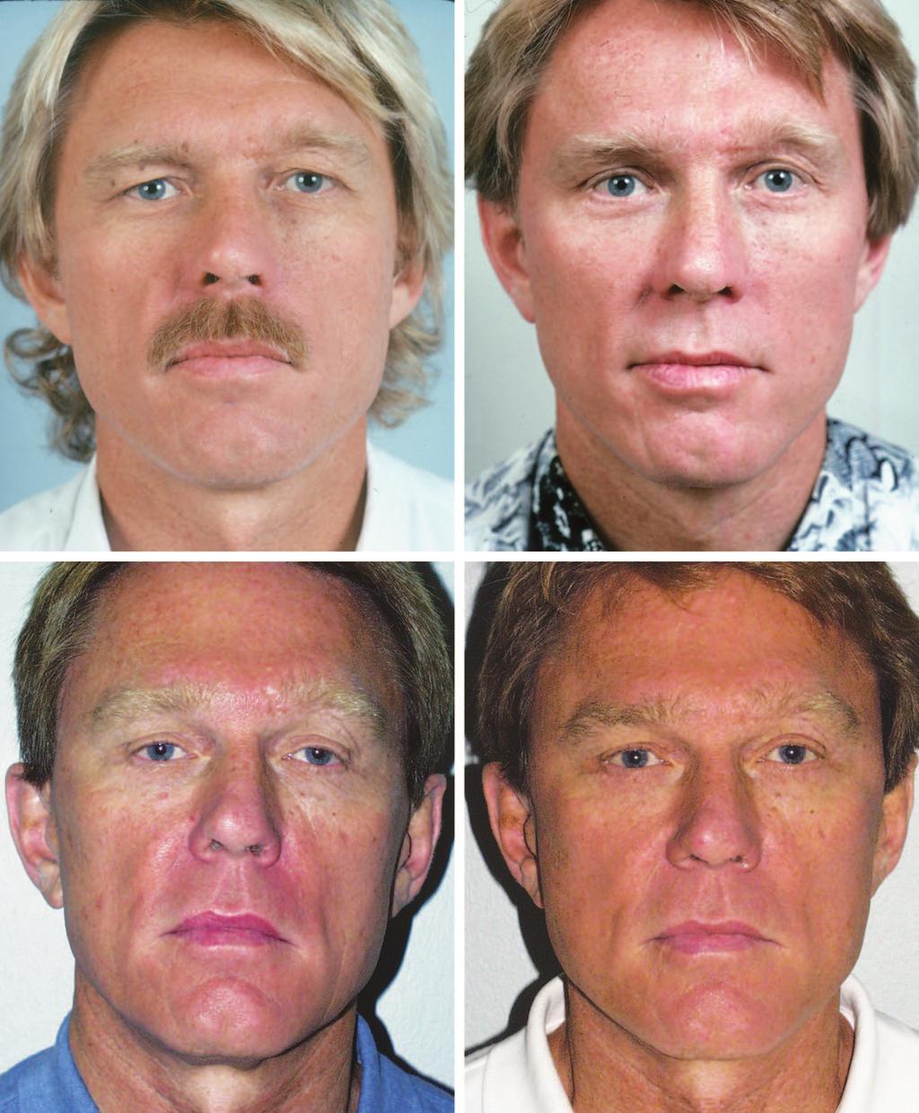 Volume 126, Number 1 Longevity of SMAS Surgery ness of the digastric muscle. Patients who report a rapid decline in skin elasticity may need an early secondary face lift.