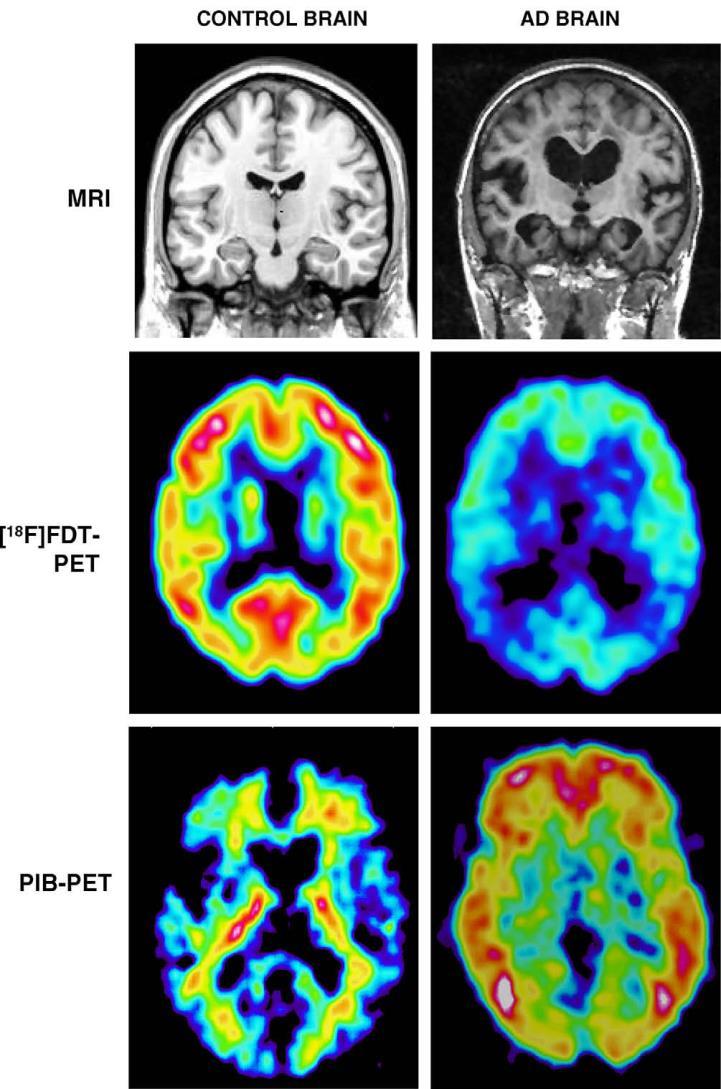 Brain Images from Age Matched Cognitively Intact Individuals
