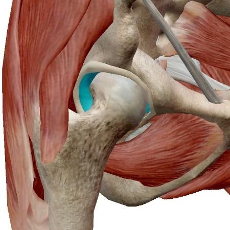 ANATOMICAL DESCRIPTION OF THE HIP JOINT The hip joint is a ball-and-socket joint, formed by the articulation of the head of the femur and the