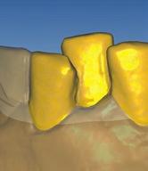 To mark missing areas of the tooth left click on the required area and mark it yellow.
