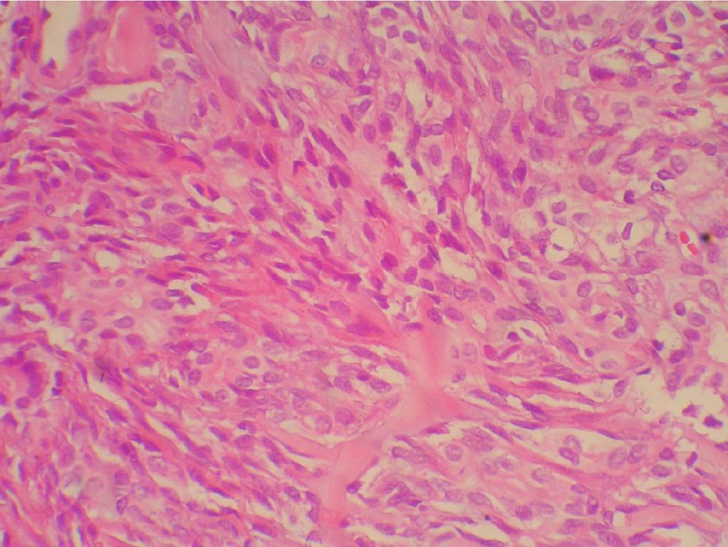 Silva HAP et al. DISCUSSION Figure 3 - Spindle cells arranged in fascicles, with stroma-like presentation (HE staining, 400x).