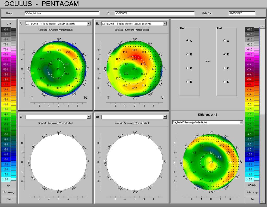 Corneal Wavefront ablation Precise local spot positioning important for: