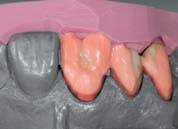If wax-up available, dentin