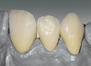 Overlay Opaque Dentin with matching enamel