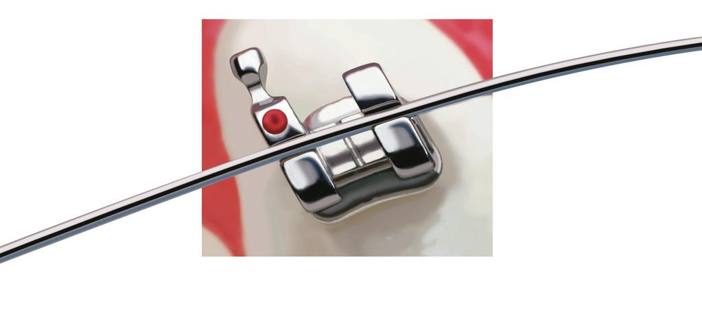 7.2 Archwire Products Over forty years ago 3M pioneered the use of nickel-titanium into orthodontists wire progression plans, creating what would be one of the top ten innovations in orthodontic