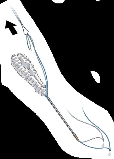 While maintaining minimal tension on the suture, find the prepared hole with the nose of the Knotless ALLthread Suture Anchor.