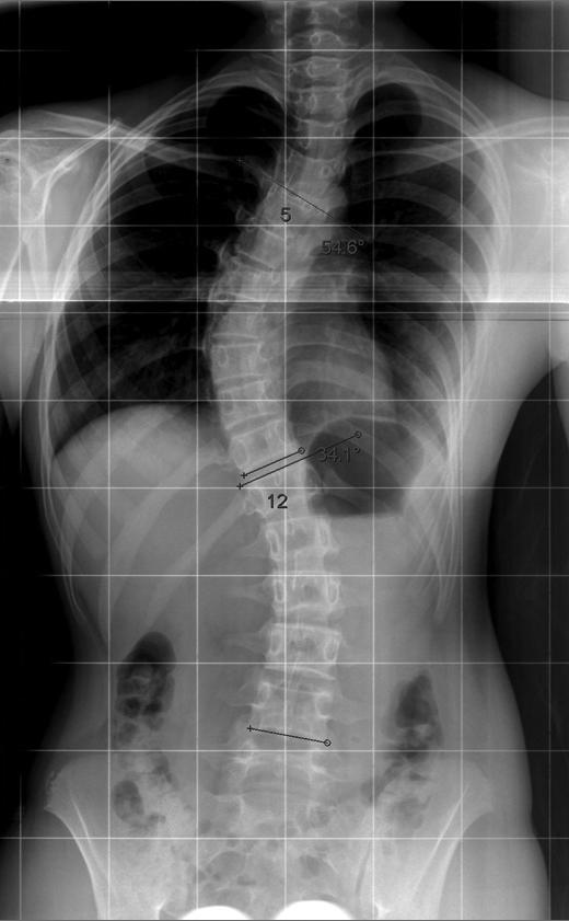 Scoliosis occurs in approximately 2-3% of the population, a person who has scoliosis will present an abnormal lateral deviation or deviations of the spine in the coronal plane.