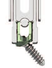 Unscrew the T-handle from the inner shaft to complete disassembly. The Locking Persuader has two bars that push down on both sides of the rod.