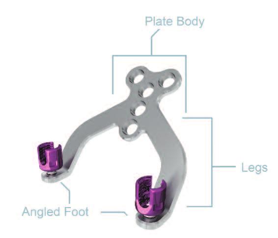 Occipital Fixation Implant Overview OASYS implants are intended for use as an aid in spine fusion. Use with bone graft is recommended.