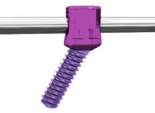 The Non-Biased Angle Polyaxial Screws are available in diameters of 3.5mm, 4.0mm and 4.5mm. The 3.5mm and 4.0mm screws are 10 to 20mm in length in 2mm increments while the 4.