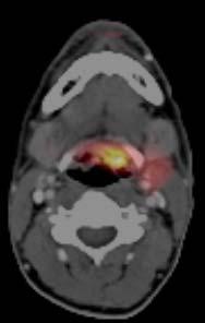 Findings: PET/CT reveals focal uptake of FDG in left base of the tongue consistent with the