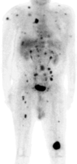 Metastatic Melanoma 71-year-old male with metastatic melanoma on left shoulder discovered 12/94. CT performed on 7/10/95 demonstrated tumor of the distal femur with negative findings in the abdomen.