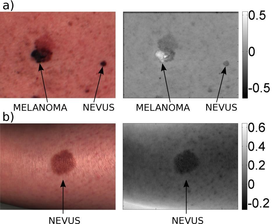Melanoma-nevus differentiation