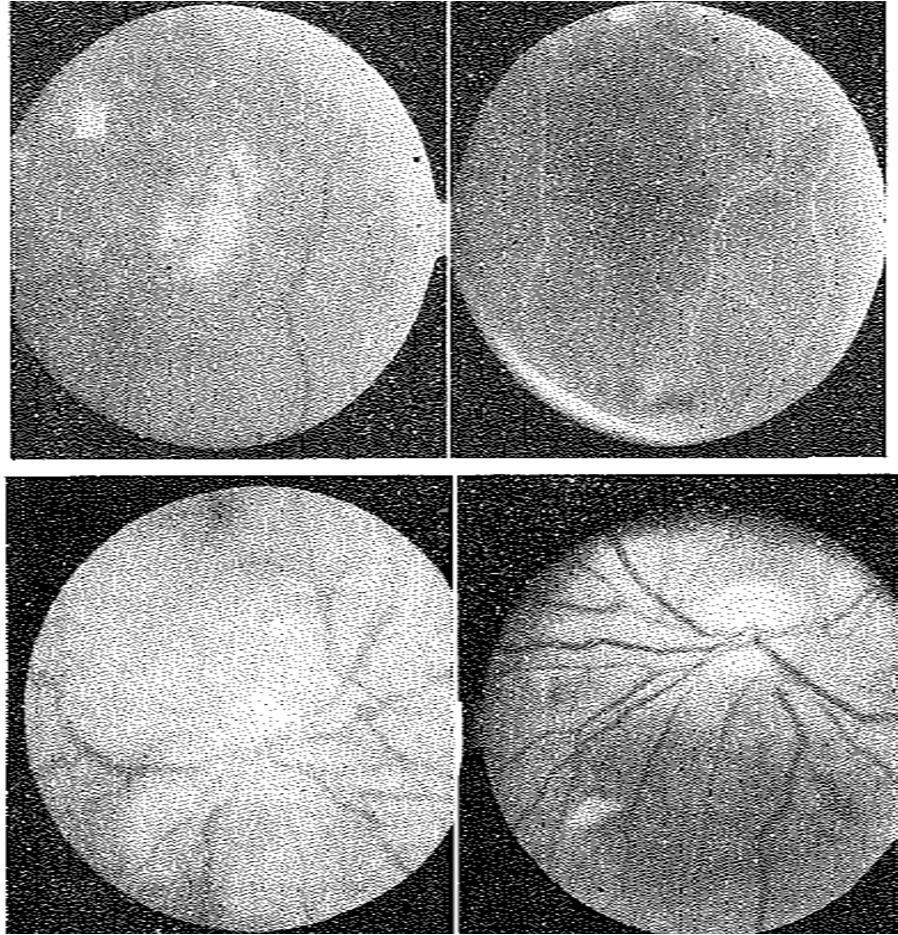 Retinophaty in Diabetic Patients Retinography of the right eye, vascular area with hard exudates and bleeding without apparent signs of ischemia Grade I/II?