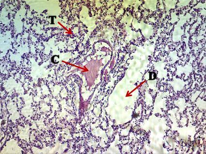 Figure (11): Lung section of 15 mg cypermethrin group shows marked dilatation (D) alveolar spaces,