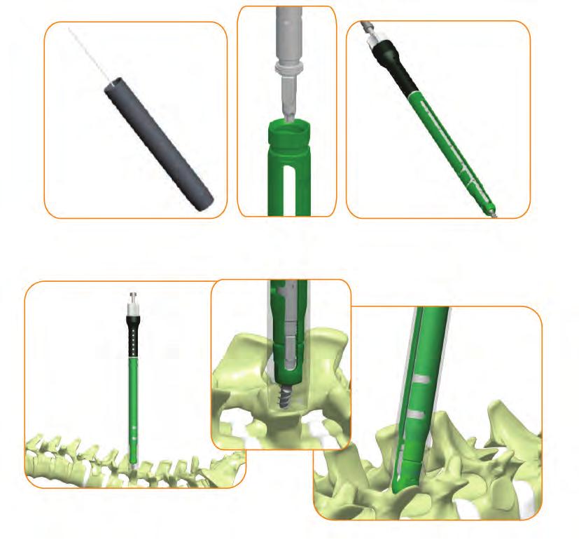 Minimally Invasive Spinal System 5. Screw Impant Once tapping is complete, remove the Tap and insert the radiolucent Dilator #5 over Dilator #4. Remove Dilator #4.