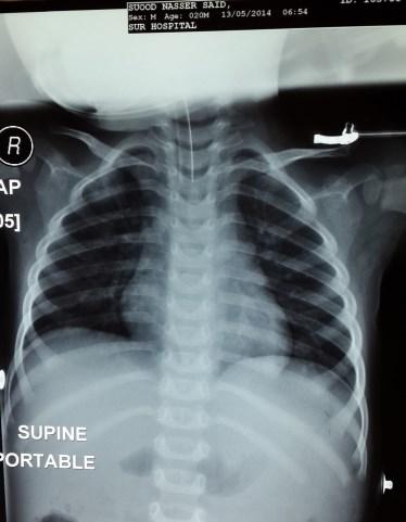 Post operative chest x-ray showing clear Lung fields Discussion Foreign body aspiration poses a big diagnostic and therapeutic challenge to otorhinolaryngologists around the globe (1).