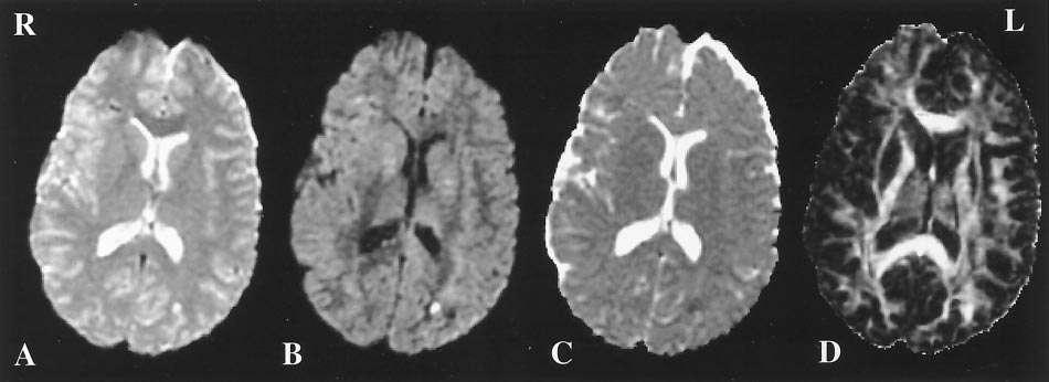 MRI Ascertainment of Lesions Arfanakis et al. AJNR 2002 A. Small hemorrhagic lesion in left occipital lobe B. DWI shows same lesion C.