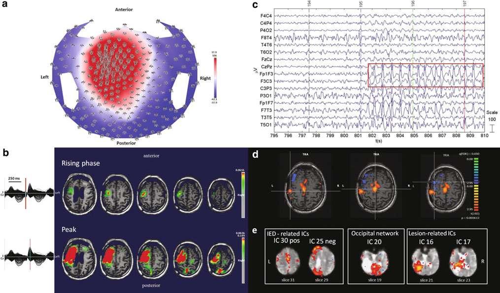 Multimodal Imaging High density EEG,