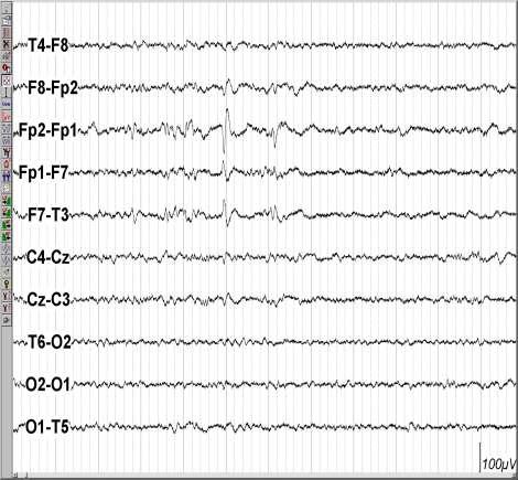 Interictal EEG
