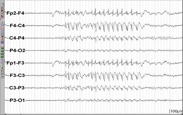 Interictal EEG EEG may