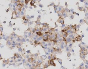 Breast Ductal Carcinoma Osteosarcoma Fibrosarcoma T cell non-hodgkin Lymphoma PD-L1 Analyte Control DR staining Cell Signalling Technologies Clone: SP263 Performed on the Roche Ventana Benchmark