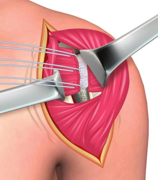 In most cases, a full thickness capsulotomy releasing both subscapularis and capsule simultaneously may be performed for exposure. The vertical limb of the capsulotomy begins 1.