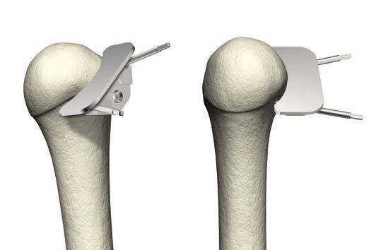 The guide can be removed and the cut completed freehand or refined with a rongeur; any residual osteophytes, especially posteriorly, should be resected using an osteotome.
