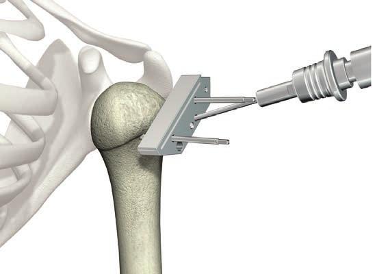 Operative technique ReUnion RSA Shoulder System Humeral head resection and canal reaming When the level of the humeral head resection is confirmed.