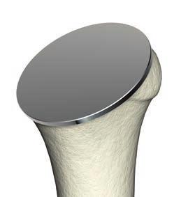 This will protect the humerus during retraction, for glenoid prepration.