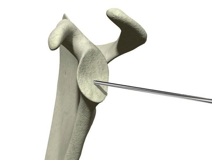 Operative technique ReUnion RSA Shoulder System Glenoid preparation Reaming and planing the glenoid Select the appropriately sized glenoid reamer/ planar and assemble it to the cannulated straight