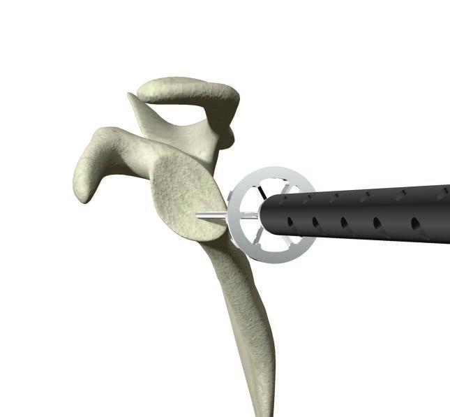 Tech tip: If the user is uncertain at this step which glenosphere size will be utilized, it is recommended that the largest size glenoid reamer/planar be used that the patient s anatomy will