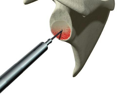 Operative technique ReUnion RSA Shoulder System Glenoid preparation Measuring depth/length for center screw Glenoid baseplate center screw length selection may be determined using the following