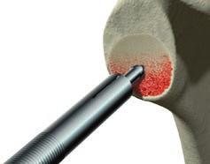 When utilizing the depth gauge be sure to engage the far cortex with the hook of the depth gauge and place the tip of the instrument against the glenoid face before reading the measurement [Figure 64