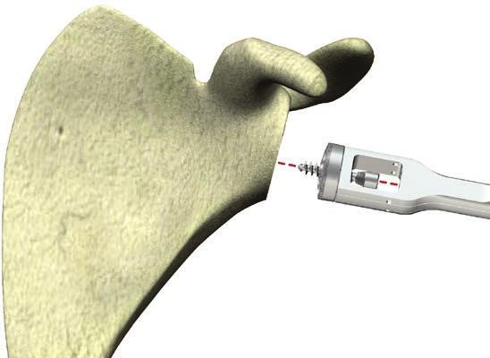 Figure 70 Apply an axial force towards the face of the glenoid [Figure 72] while holding the baseplate holder firmly in place to prevent rotation of the glenoid baseplate.