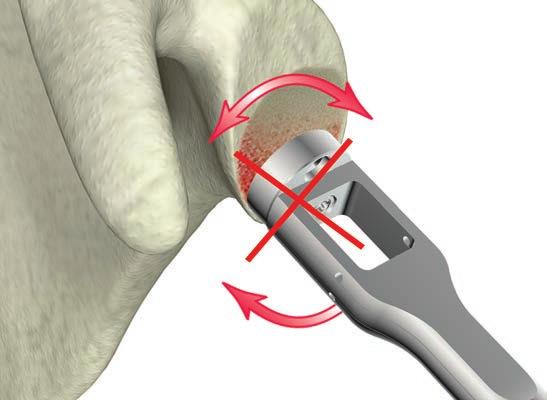 performed to confirm there are no gaps between the reamed surface and the glenoid baseplate.