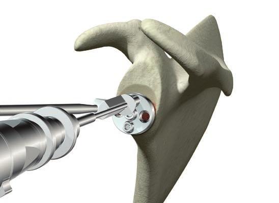 0945 ReUnion RSA -proof 3 ReUnion RSA Shoulder System Operative technique Glenoid preparation Peripheral screw placement The intent of peripheral screw placement should be to engage the maximum