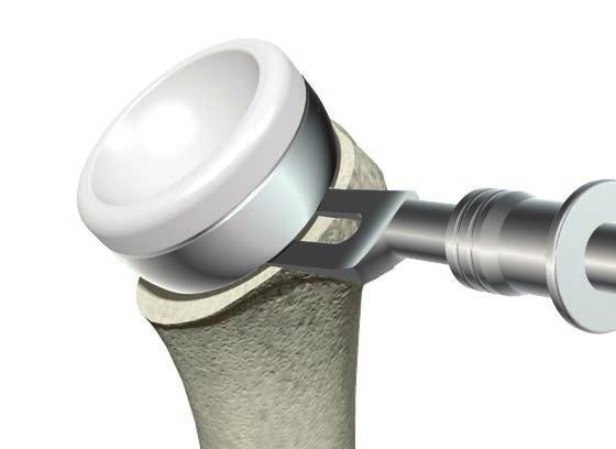 1mm drill bit to the flat bottom surface of the humeral cup away from the sides and the locking features of the X3 humeral insert.