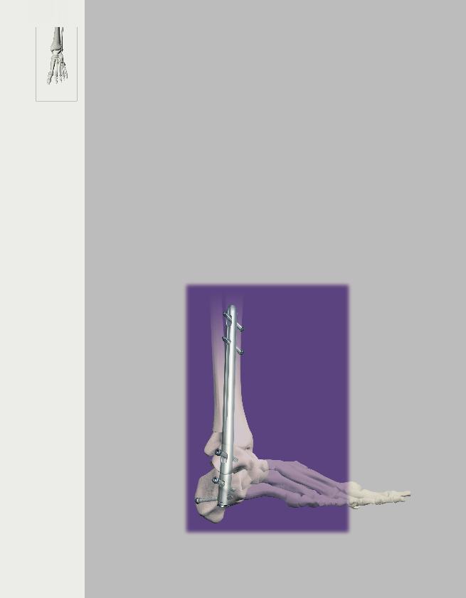 Foot & Ankle T2 Ankle Arthrodesis