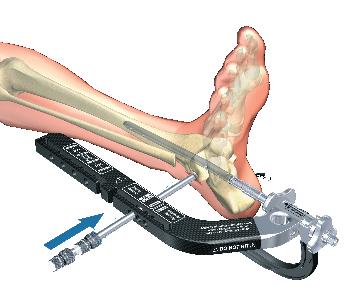 Guided Locking via Target Device Apposition/Compression Locking Mode The T2 Ankle Arthrodesis Nail provides the option to achieve active mechanical apposition/compression.