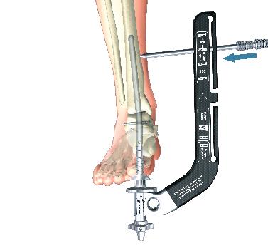 The 300mm Nails can be locked proximally only with the free-hand technique. Release the Nut and turn the Target Arm around the Nail Adapter until it can be locked in the Medial Locking position (Fig.